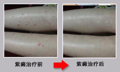 皮肤紫癜