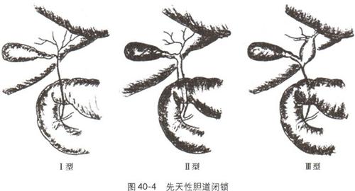 胆道闭锁