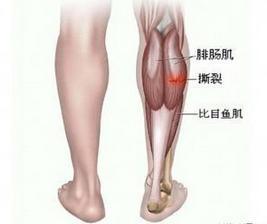 腓肠肌痉挛