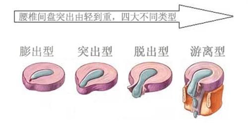 腰椎膨出