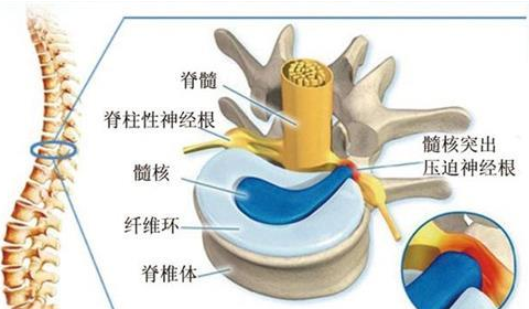 腰椎膨出