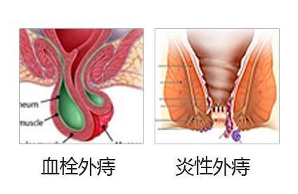 血栓外痔
