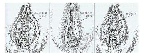 阴唇发黑