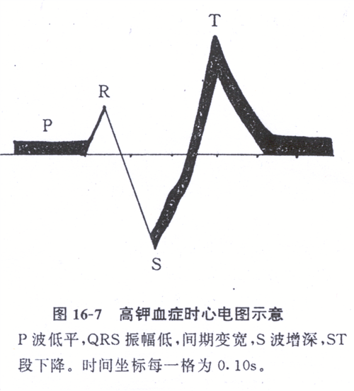 高钾血症