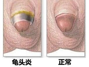 龟头瘙痒