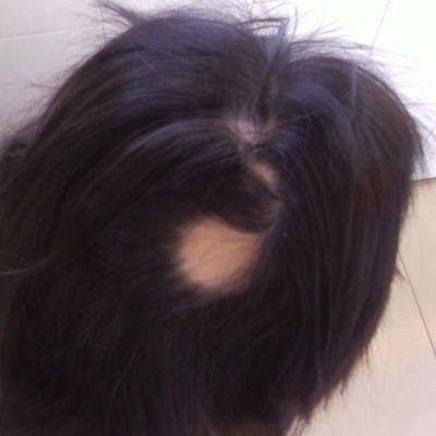 梅毒性脱发