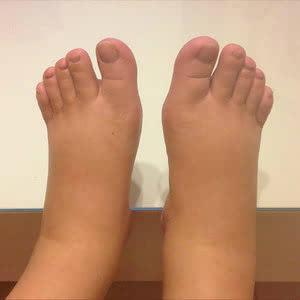 隐性水肿