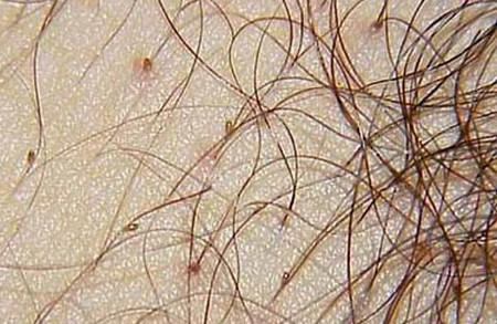 pubis)是虱病的一种,是由寄生在人体阴毛和肛门周围体毛上的阴虱叮咬