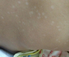 疾病 > 疾病图片 > 正文 婴儿汗斑图片  婴儿汗斑即是花斑糠疹,旧称