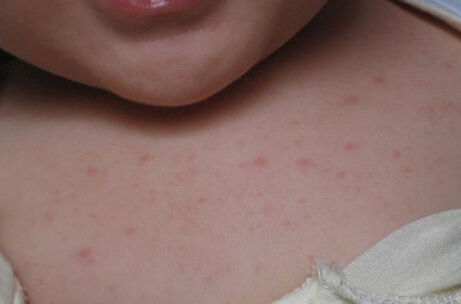 幼儿急疹的影响