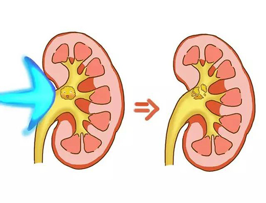 07尿结石排出来的图片