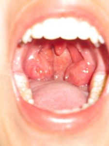 扁桃体肥大指的是一种临床症状,表现为口腔中的扁桃体体积病态增大
