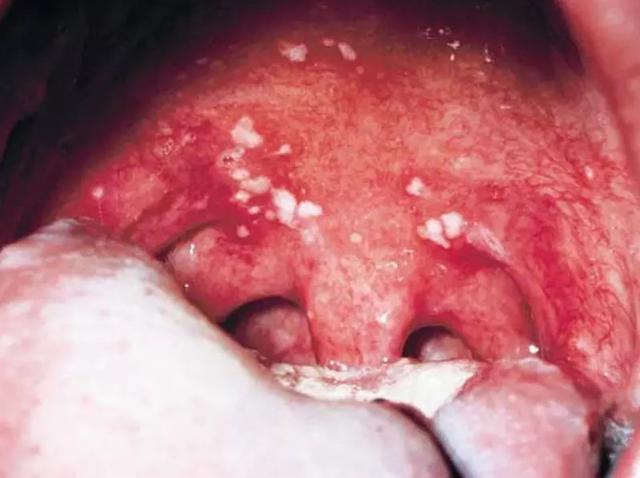 疱疹性咽峡炎图片