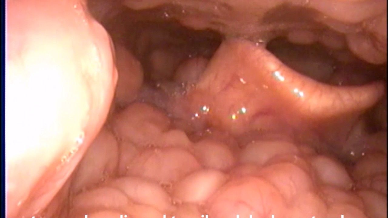 慢性咽喉癌图片