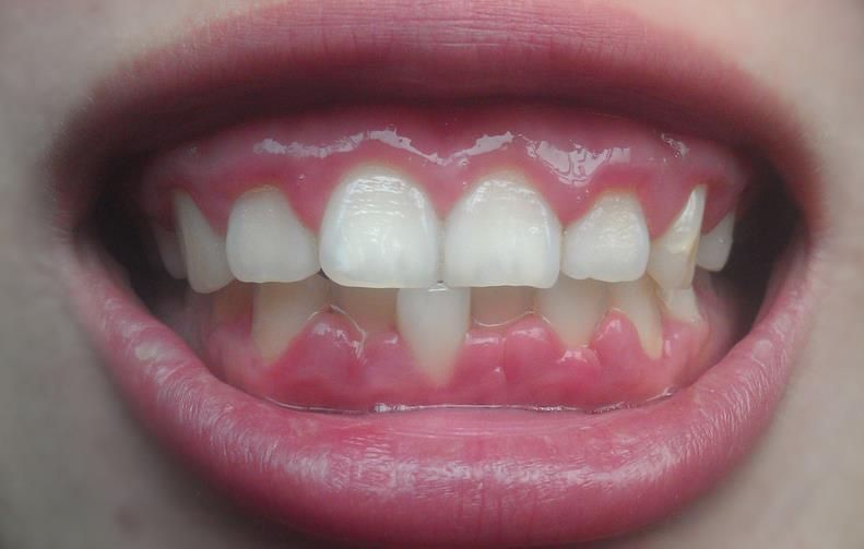 牙龈萎缩初期图片