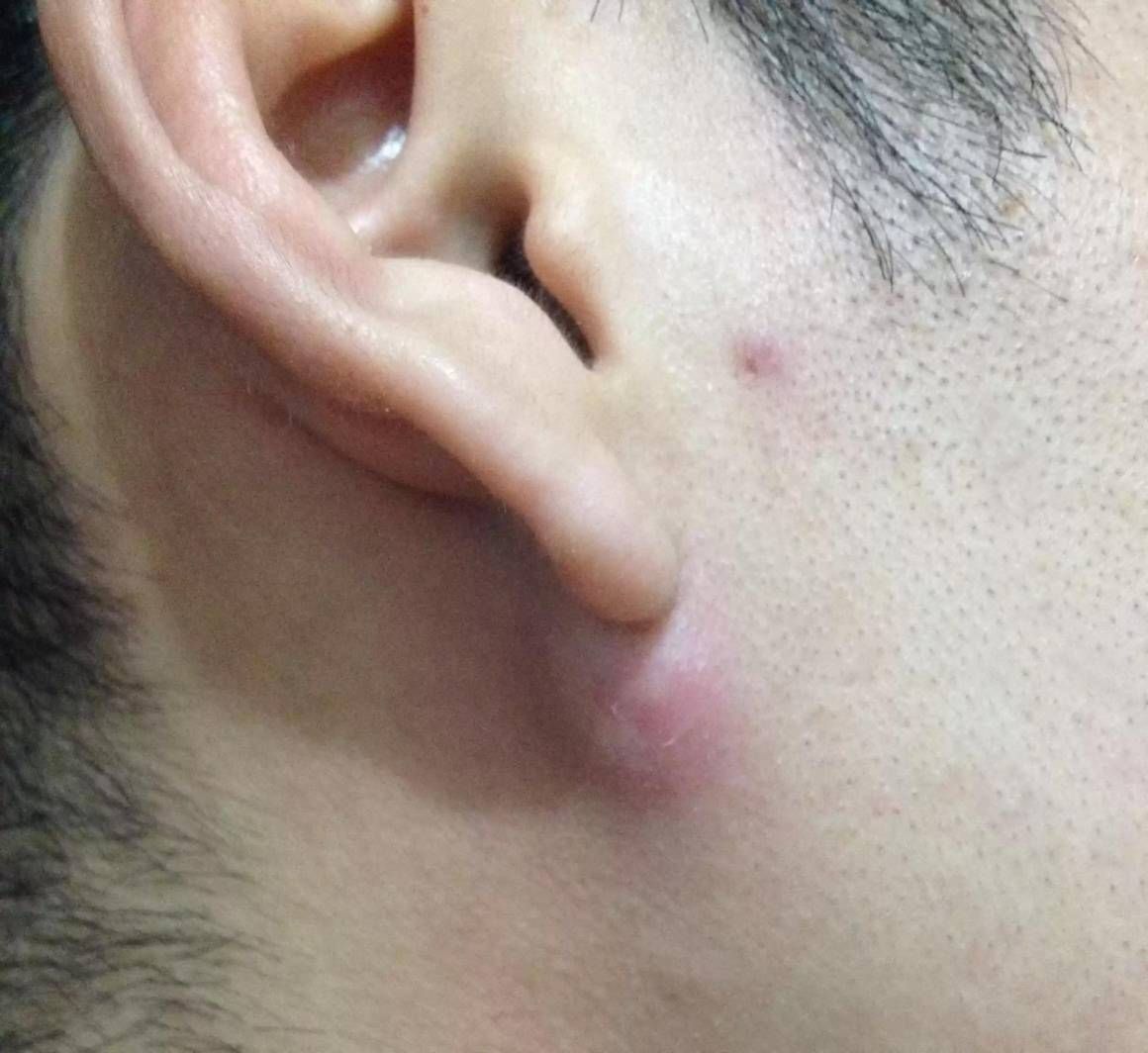 耳朵里长痘痘是一种什么体验？ - 知乎