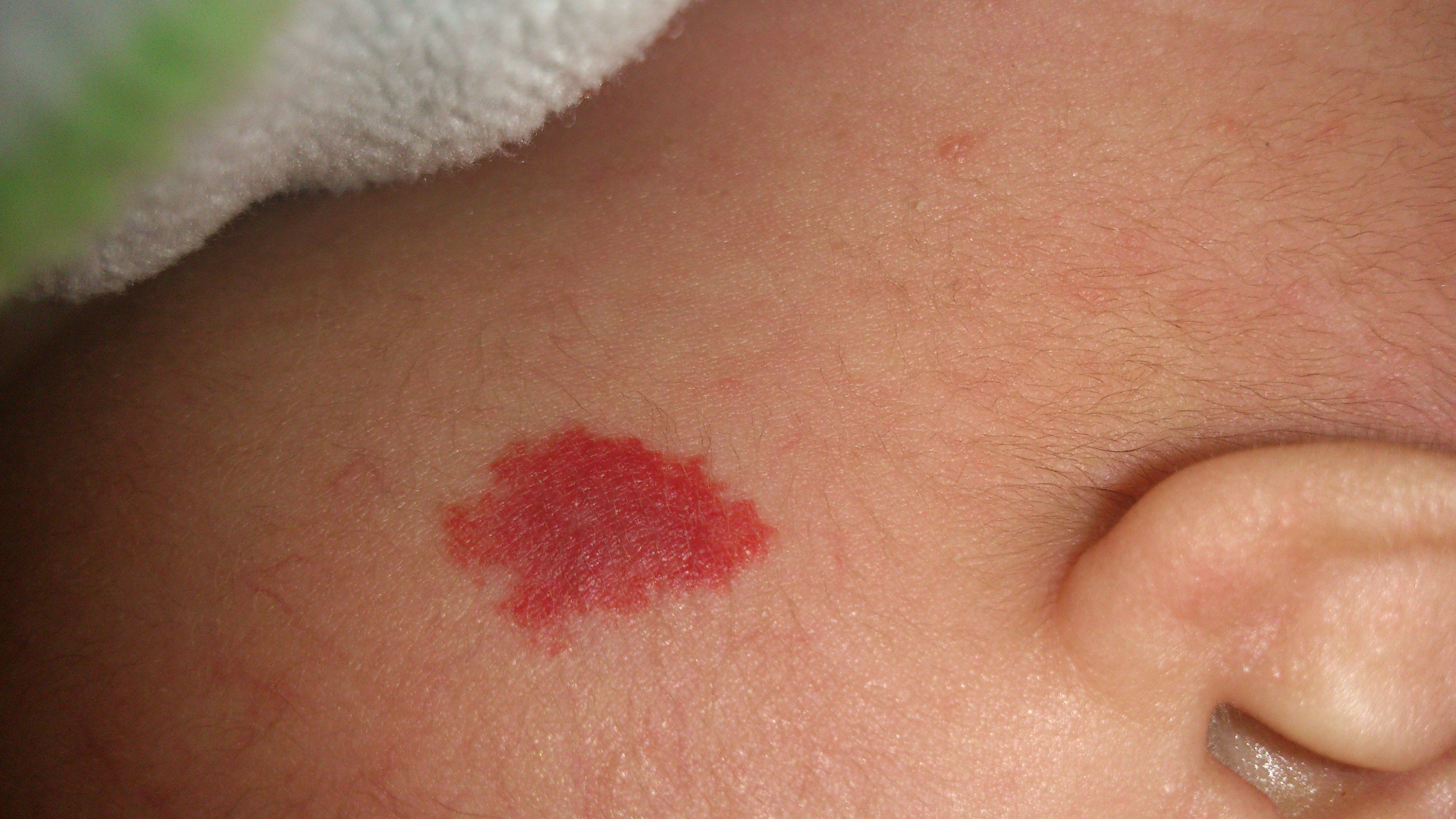 婴儿长了红色斑块，当心血管瘤 - 知乎