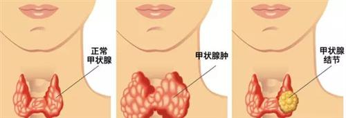单纯性甲状腺肿