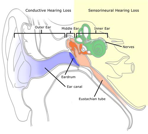 听力障碍