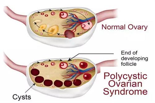 多囊卵巢综合征