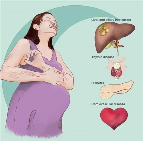 妊娠期肝内胆汁淤积症