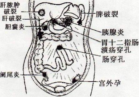 急性化脓性胃炎