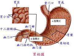 急性化脓性胃炎