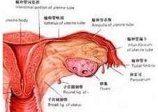 急性输卵管炎