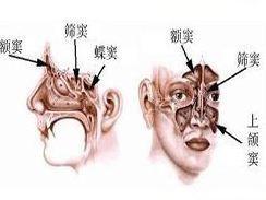 急性额窦炎