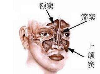 急性额窦炎