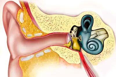 慢性中耳炎