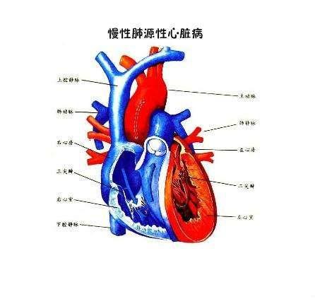 慢性肺源性心脏病
