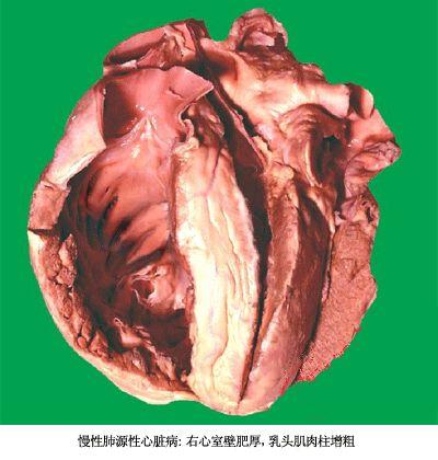 慢性肺源性心脏病