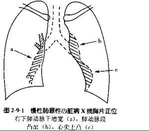 慢性肺源性心脏病