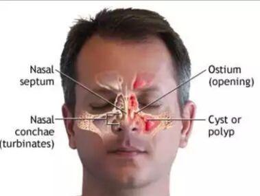 慢性鼻窦炎