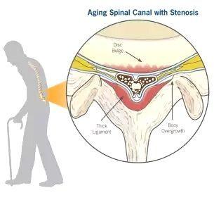 椎管狭窄