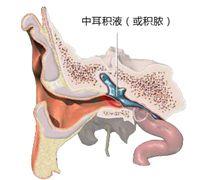 粘连性中耳炎