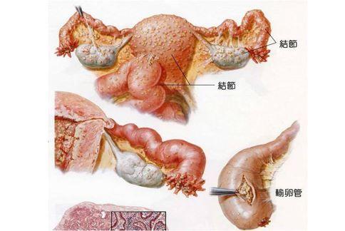 结核性宫颈炎