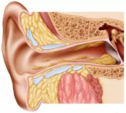 耵聍栓塞