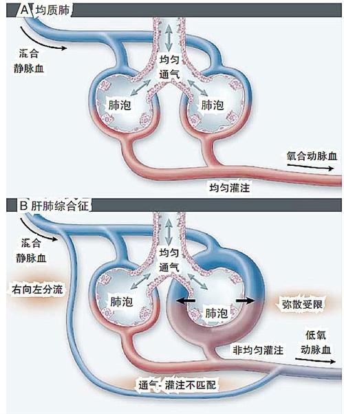 肝肺综合症