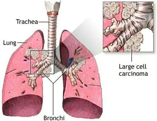 肺部肿瘤