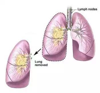 肺部良性肿瘤