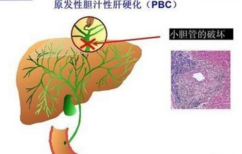 胆汁性肝硬化