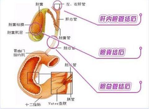 胆石