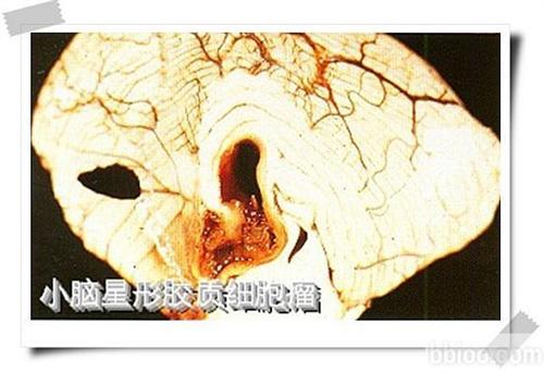 胶质细胞瘤