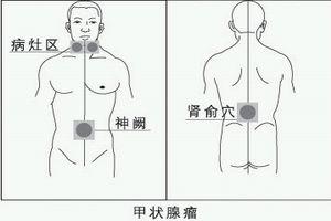 胸内甲状腺肿