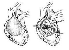 胸腹主动脉动脉瘤