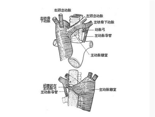 腹主动脉缩窄