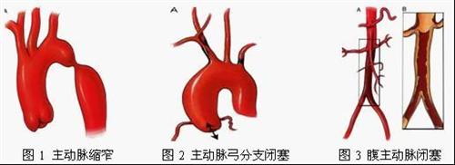 腹主动脉缩窄