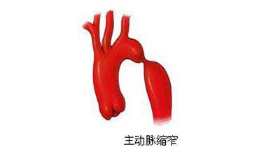 腹主动脉缩窄